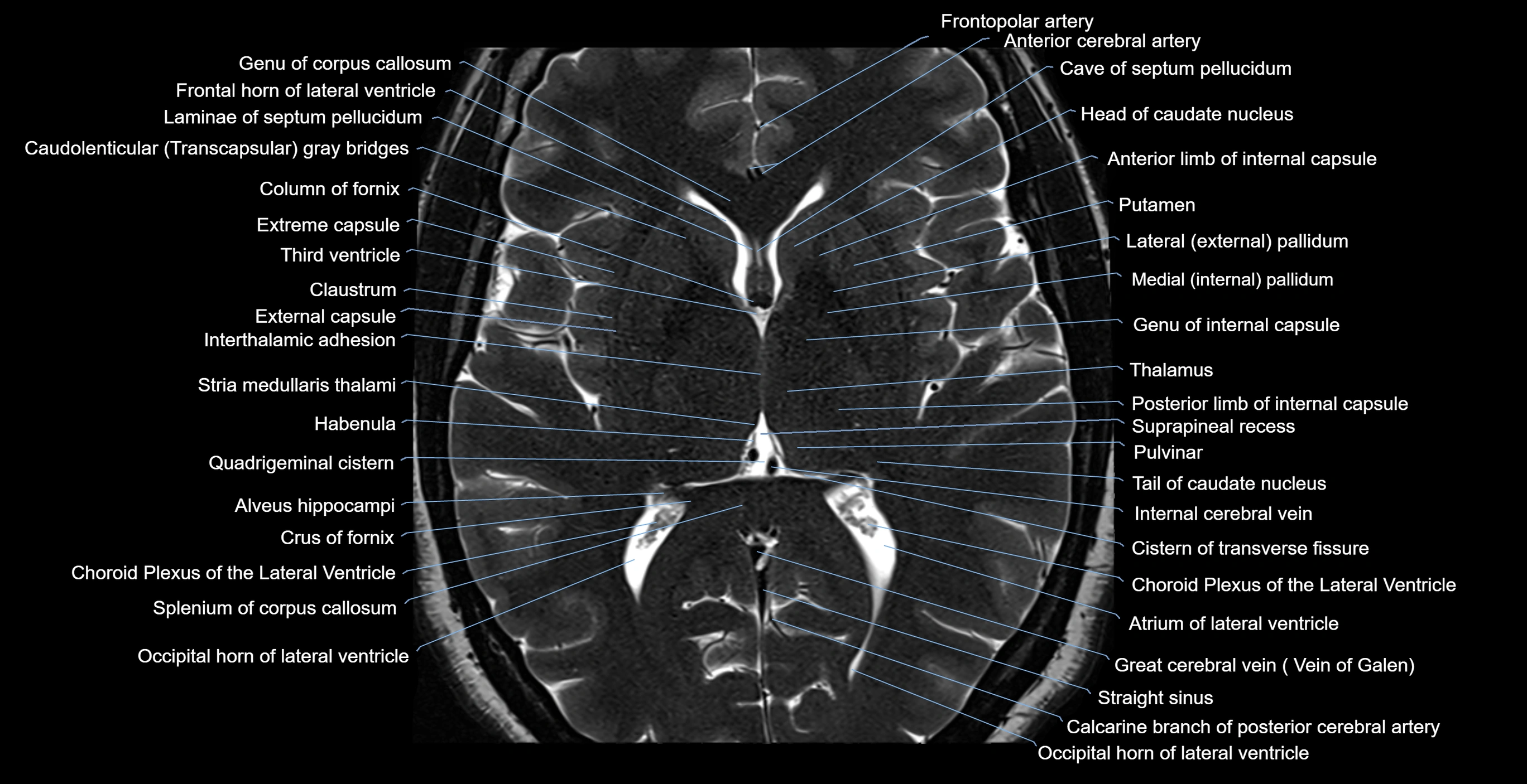 brain axial anatomy 3T MRI images -img-17001-00033.webp